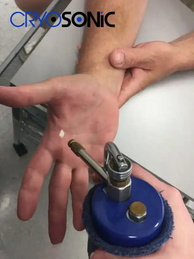 Temperature Differences: OTC vs Medical-Grade Cryotherapy Esher